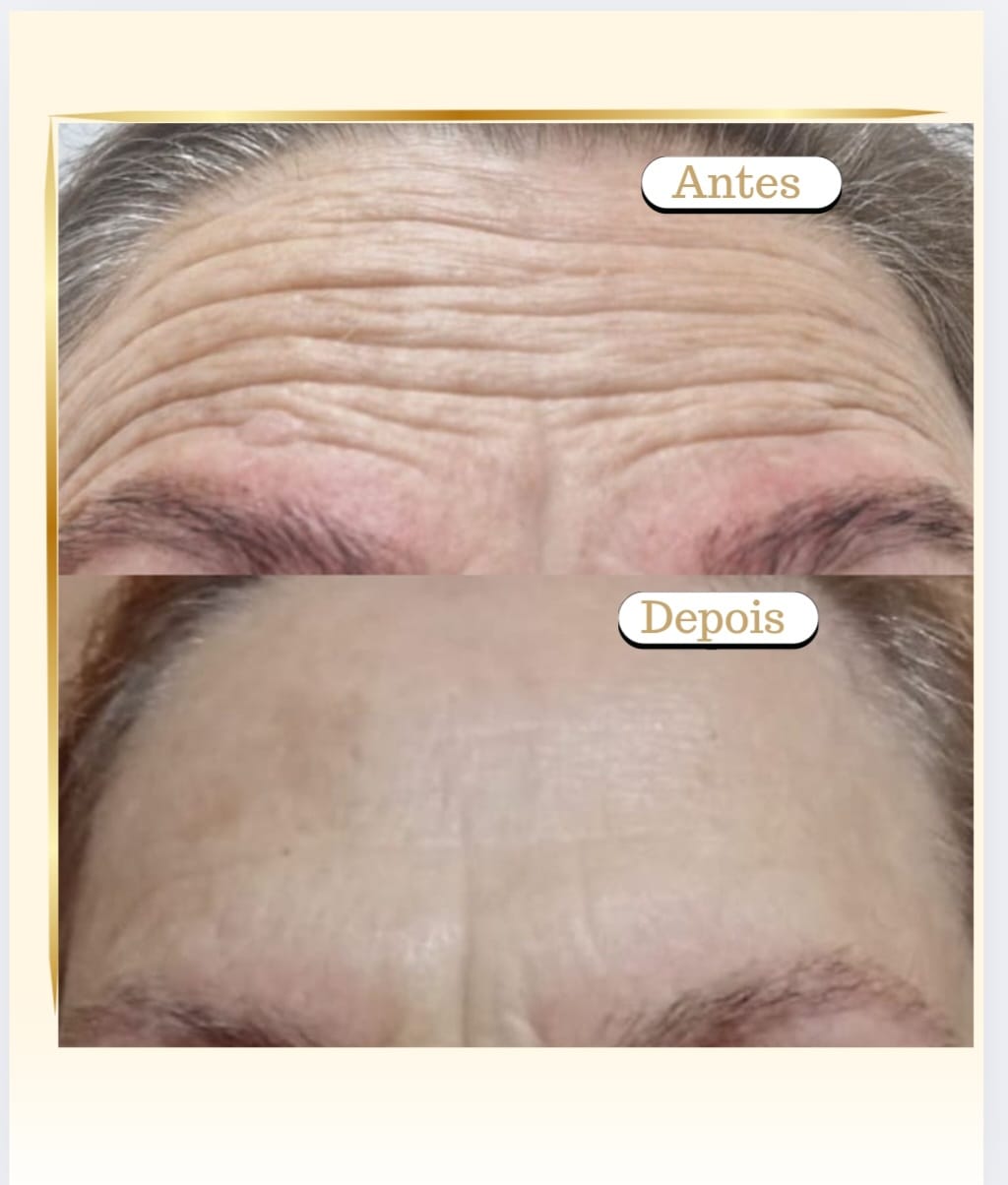 Botox Caso 3