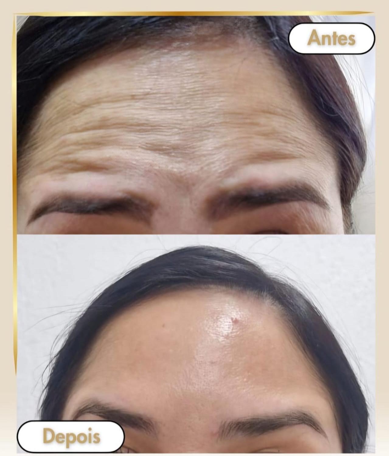 Botox Caso 4