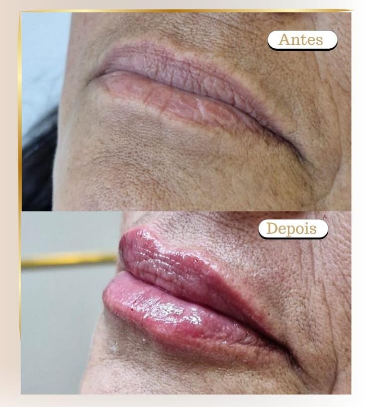 Preenchimento Labial 1