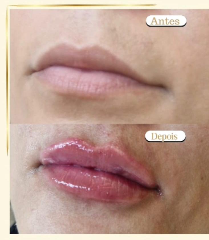 Preenchimento Labial 2