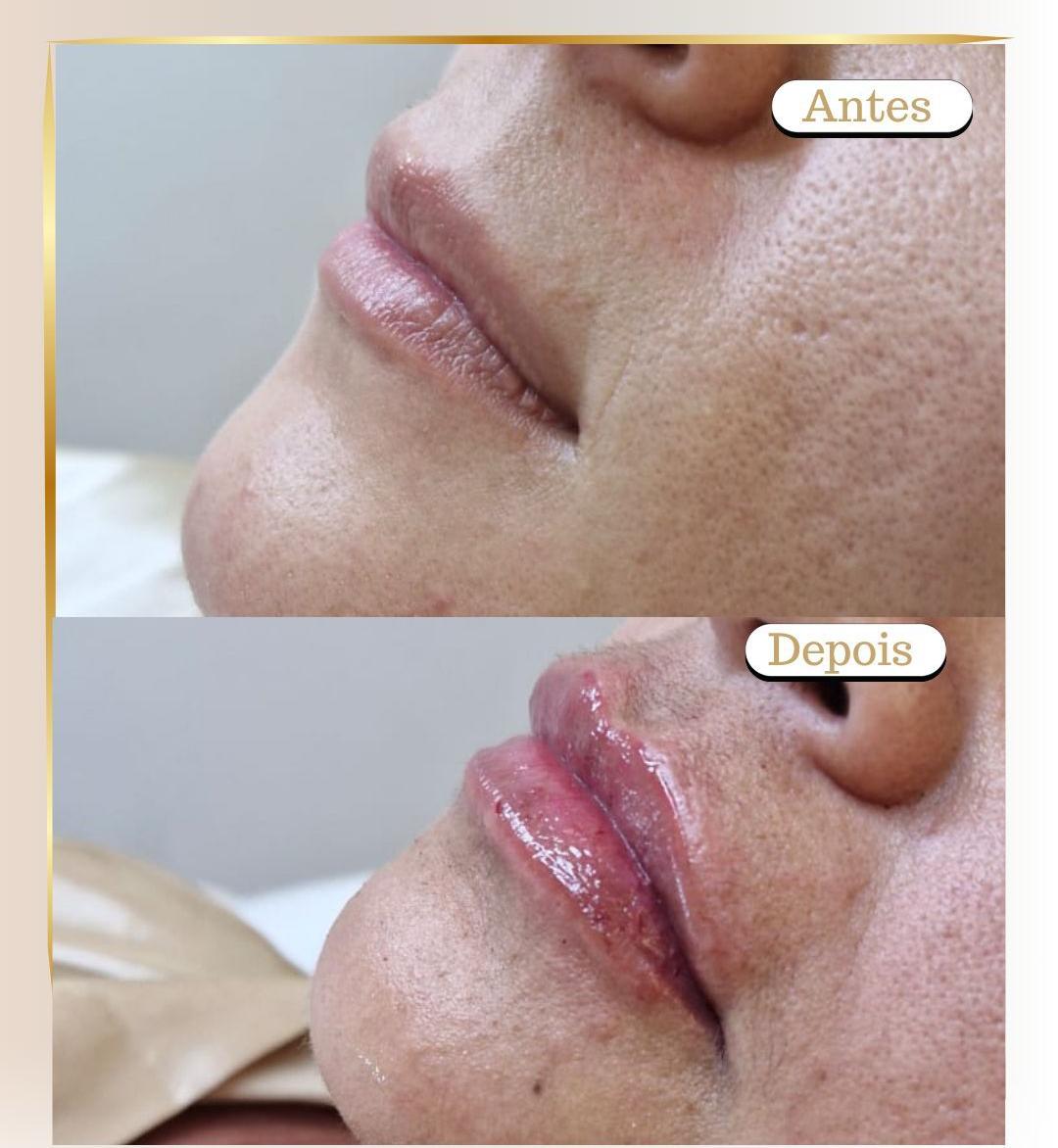 Preenchimento Labial 3