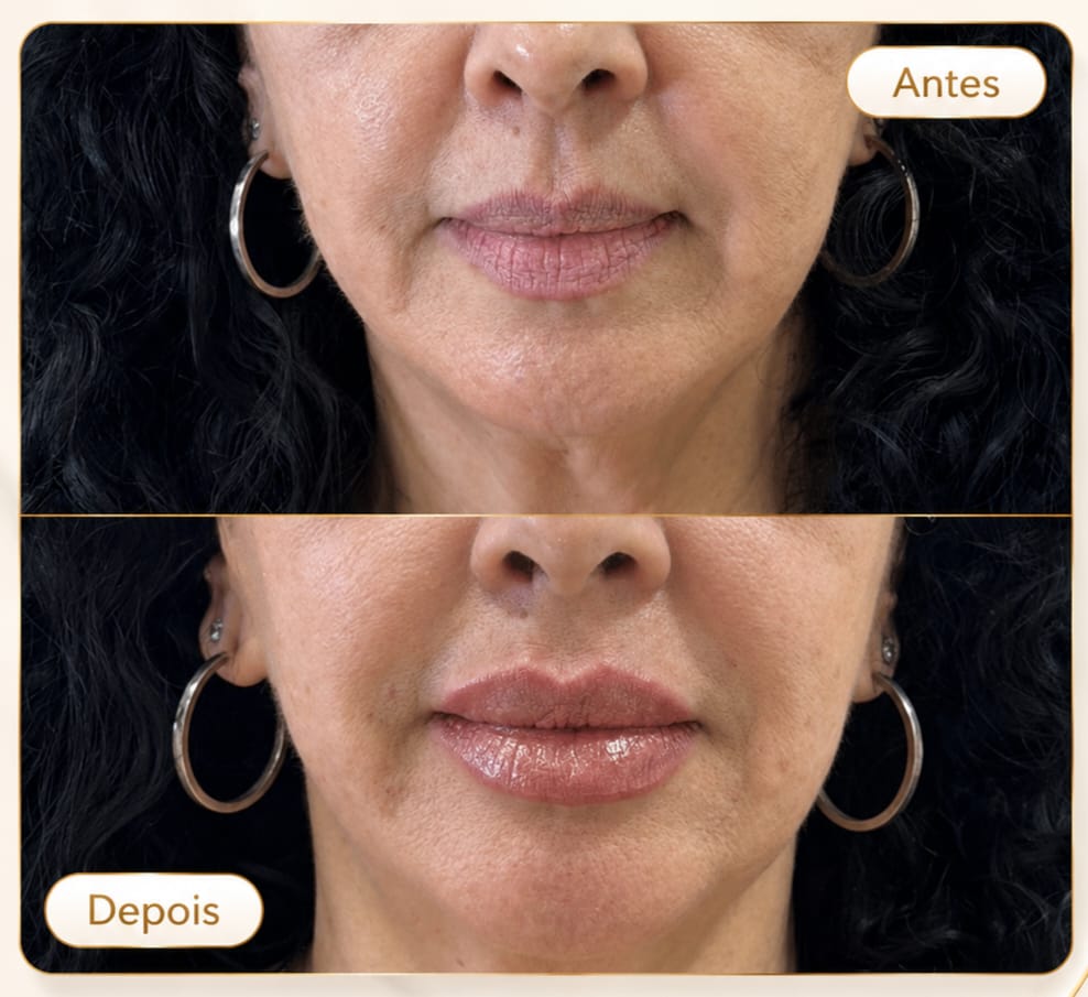 Preenchimento Labial 4