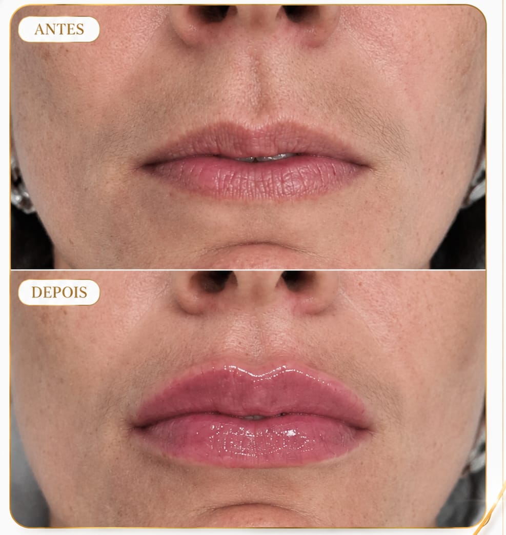 Preenchimento Labial 5